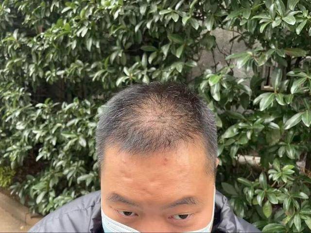 “还能反光<strong></p>
<p>btc期货</strong>！”长沙男子植发近9月称后脑勺“像狗啃过”