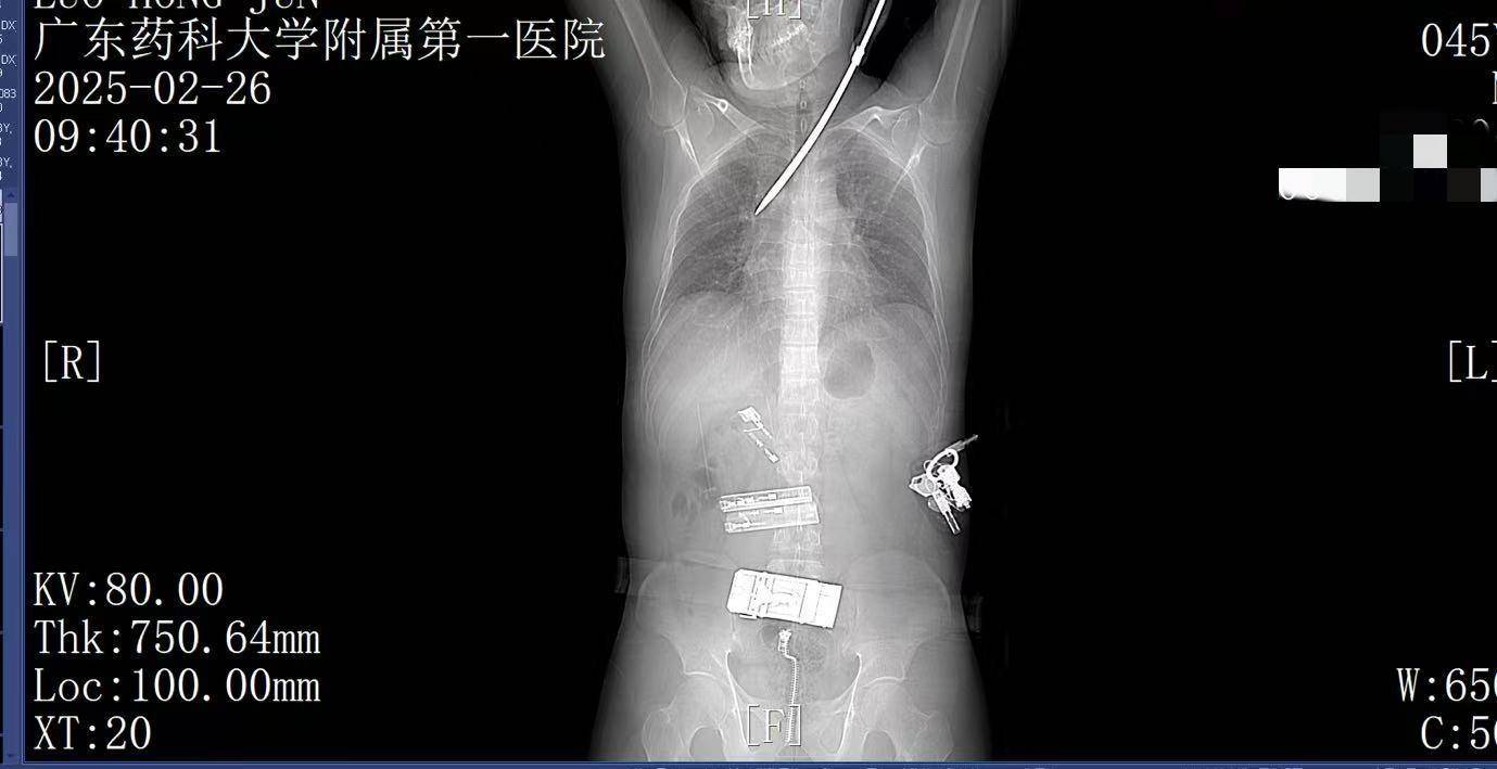 20米高空掉落螺丝刀直插男子胸腔<strong></p>
<p>btc地址</strong>！医生：不要自行拔除