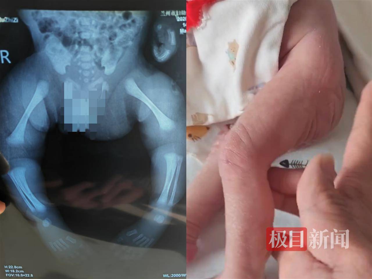 二胎出生查出先天性病症或落下残疾<strong></p>
<p>充值usdt平台</strong>，残疾父母称医院产检漏检、未尽告知义务，医院及医调委回应