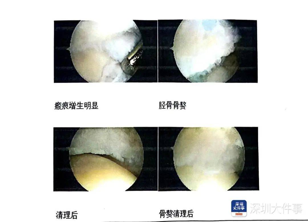 “一走路就痛”！女子脚踝受伤遭漏诊<strong></p>
<p>usdt今日价格</strong>，治了7年没好！深圳一医院被告上法庭