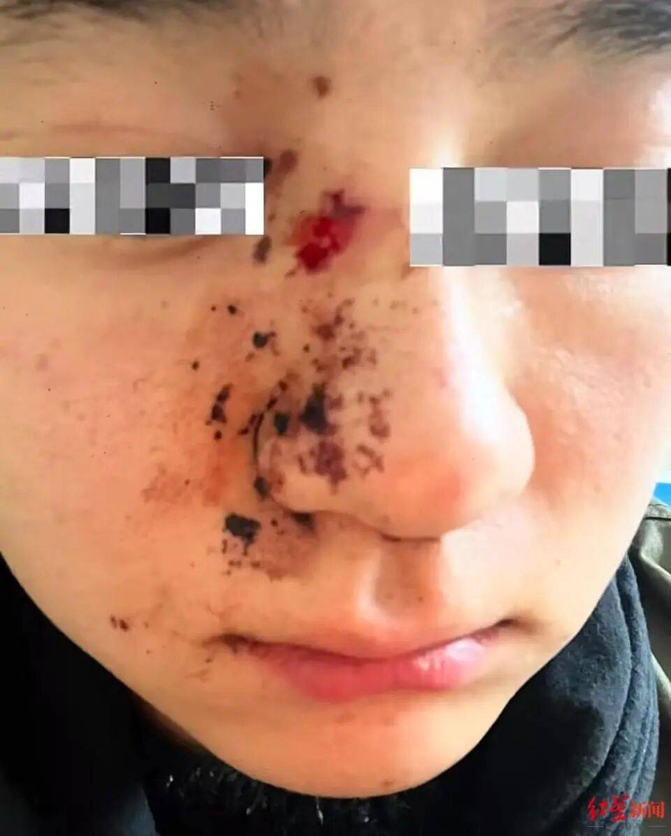 男子因质问女子遛狗不牵绳被打骨折<strong></p>
<p>以太坊技术</strong>，当事人：打人者毫无悔意