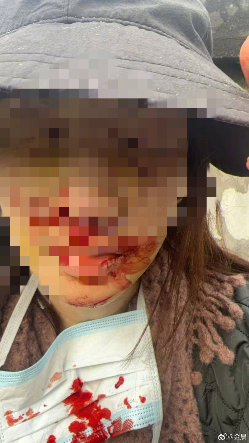 警方发布警情通报后<strong></p>
<p>比特币怎么买</strong>,金晨晒脸部受伤照片并发文道歉